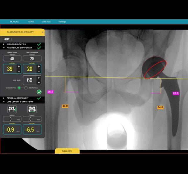 Meet Radlink One Touch, our redesigned Surgeon’s Checklist® software interface for anterior & posterior approach total hip arthroplasty. With the same measurements you trust from the original intraoperative imaging navigation system, our new interface presents a simplified workflow so you can make data driven decisions, faster.
 
Our open platform system is compatible with any implant brand and C-arm or mobile x-ray on the market #universalcompatibility
 
Stop by Booth 1029 during the American Association of Hip and Knee Surgeons (AAHKS) Annual Meeting for a demo.
 
#aahks2024 #radlink #OneTouch #orthopedicsurgery #orthopedicsurgeon #hipsurgery #AIfortheOR #ai #healthcare #technology #ortho #hip #surgeon #data #innovation